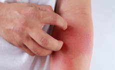C&#225;ch ph&#242;ng bệnh vi&#234;m da mủ khi thời tiết n&#243;ng nực