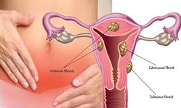 U xơ tử cung khi mang thai c&#243; ảnh hưởng đến thai nhi kh&#244;ng?