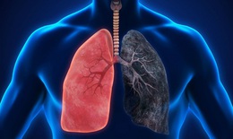 C&#225;c t&#225;c dụng phụ thường gặp khi điều trị ung thư phổi