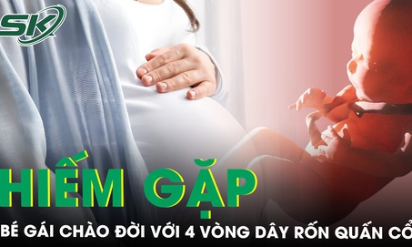 B&#233; g&#225;i ch&#224;o đời với 4 v&#242;ng d&#226;y rốn quấn cổ cực hiếm gặp