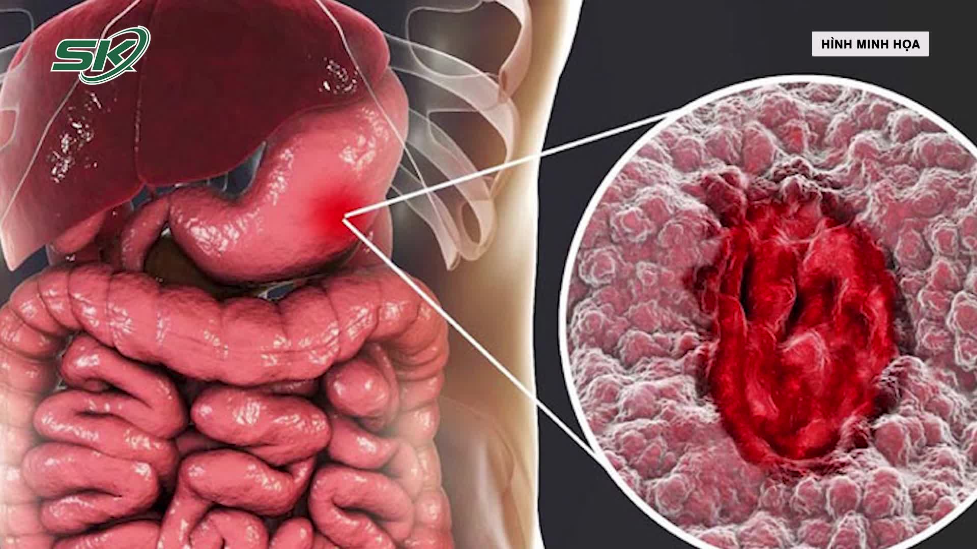 Hành Trình Đầy Khó Khăn Của Chàng Trai 17 Tuổi Chống Lại Ung Thư Di Căn
