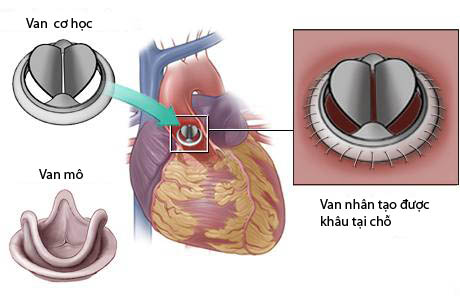 
	Hình ảnh van tim cơ học