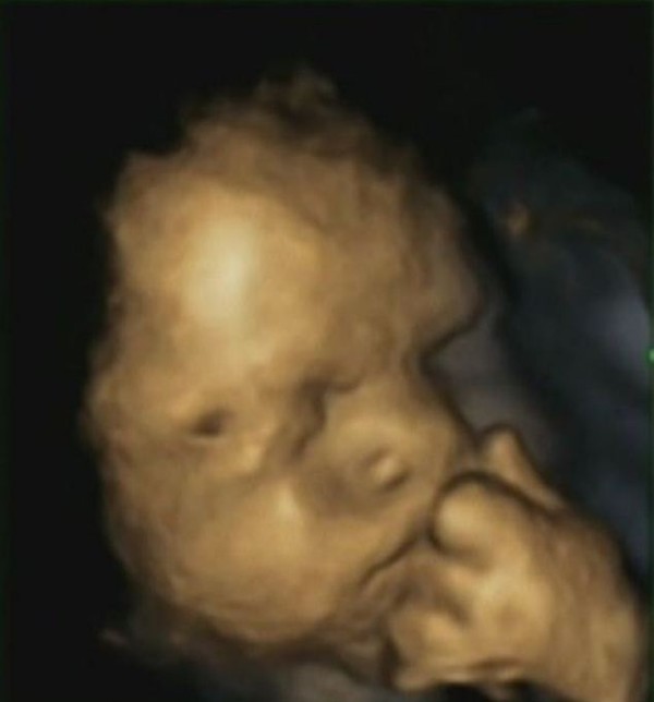 33 Hình ảnh siêu âm thai 456789 tuần tuổi