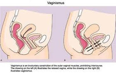 Hiện tượng co thắt âm đạo phụ nữ là triệu chứng thường gặp, nhưng để tới mức mắc kẹt thì chưa được các tài liệu khoa học và y văn ghi nhận cụ thể.