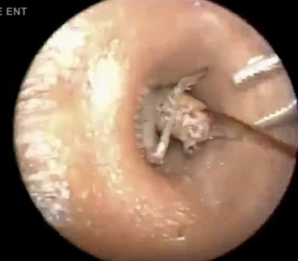 Kinh ngạc con dế khổng lồ, dài 7cm ngọ nguậy trong lỗ tai người 1 Kinh ngạc con dế khổng lồ, dài 7cm ngọ nguậy trong lỗ tai người 1