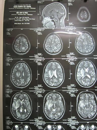 Những nốt tròn trong có nhân là nang sán lợn làm tổ dày đặc trong não bệnh nhân (Ảnh: BS cung cấp)