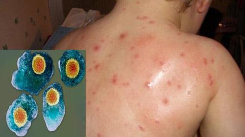 Virut Varicella - zoster gây thủy đậu (ảnh nhỏ) và tổn thương do thủy đậu trên da (ảnh lớn).