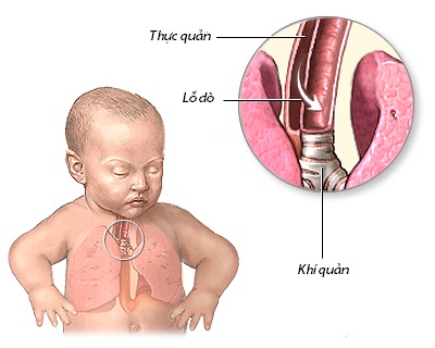 Sơ đồ dị tật lỗ dò khí - thực quản.