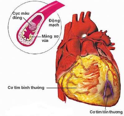 Cục máu đông làm tắc mạch vành