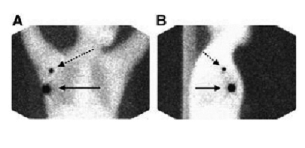 Chẩn đoán hạt nhân phóng xạ bệnh phù bạch huyết A chụp thẳng, B chụp nghiêng.