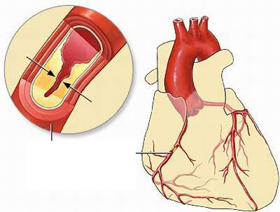 Bệnh lý mạch vành - một trong những nguyên nhân gây rung nhĩ.