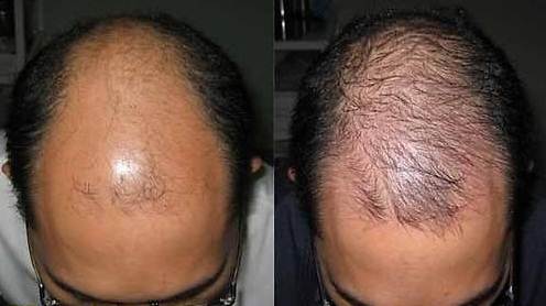 Chi tiết với hơn 55 về thuốc nam trị rụng tóc  trieuson5