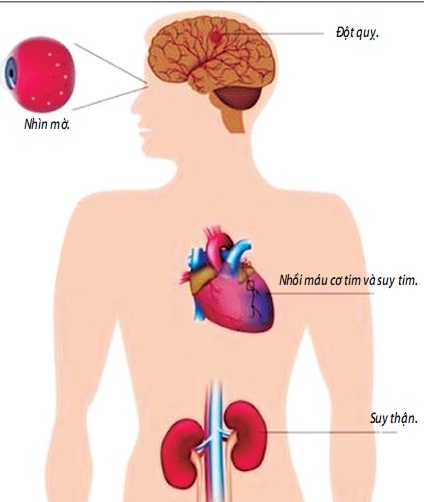 Biến chứng của bệnh tăng huyết áp.