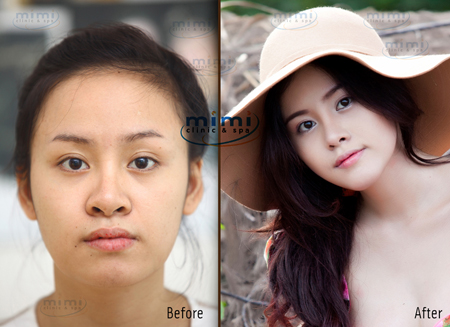 Hình ảnh: Chàng trai được phẫu thuật thành cô gái với 1 tỷ đồng số 13