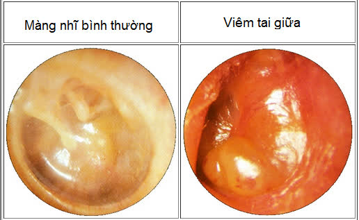 Hình ảnh viêm tai giữa.