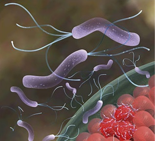 Vi khuẩn Helicobacter pylori gây loét dạ dày.