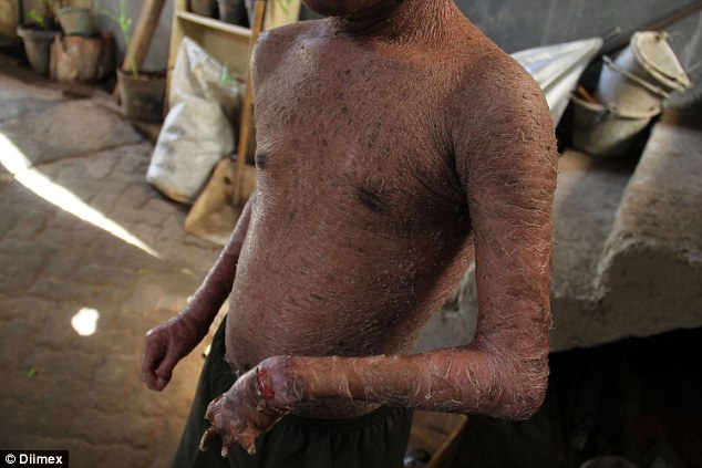 Hiện tượng lột da chỉ xuất hiện ở một số loài vật, nhất là bò sát, nhưng ở Indonesia hiện nay lại có cậu bé mắc phải căn bệnh lạ này với làn da sần sùi như vẩy rắn.