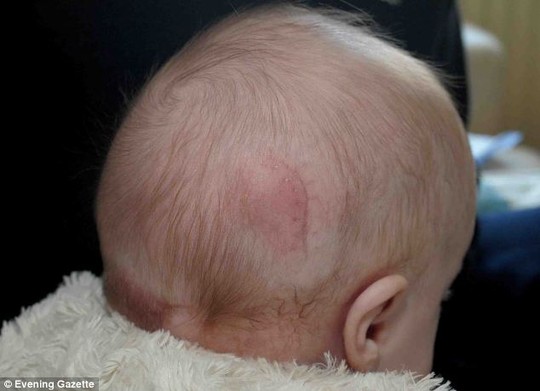 Bé Faith Martin sau phẫu thuật cắt bỏ não thừa. Ảnh: Daily Mail Bé Faith Martin sau phẫu thuật cắt bỏ não thừa. Ảnh: Daily Mail