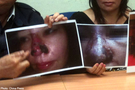 Một doanh nhân Singapore khác cũng bị hoại tử mũi do tiêm chất làm đầy