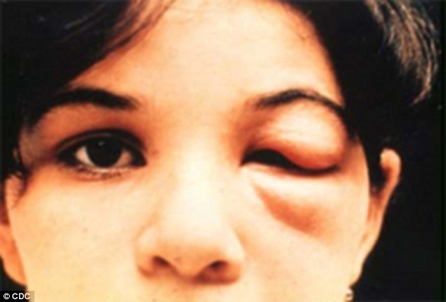 Một trong những triệu chứng của bệnh Chagas là một bên mí mắt bị sưng phù. (Nguồn: CDC)