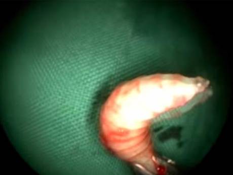 Dòi có chiều dài khoảng 1 cm, sống bằng thịt của bệnh nhân