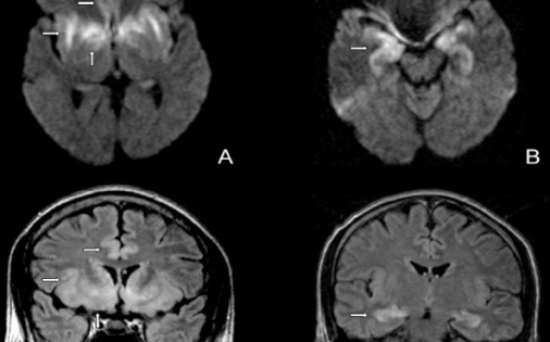 Chẩn đoán hình ảnh tổn thương não trong bệnh viêm não do Arbovirus.