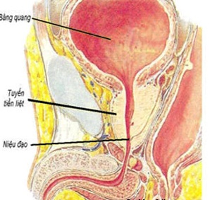 Sự phì đại của tuyến tiền liệt gây ra một số triệu chứng rối loạn tiểu tiện.