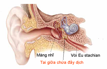 Viêm tai giữa thanh dịch