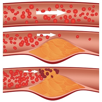 Mạch máu bình thường (trên cùng) và mạch máu khi bị tiểu đường.