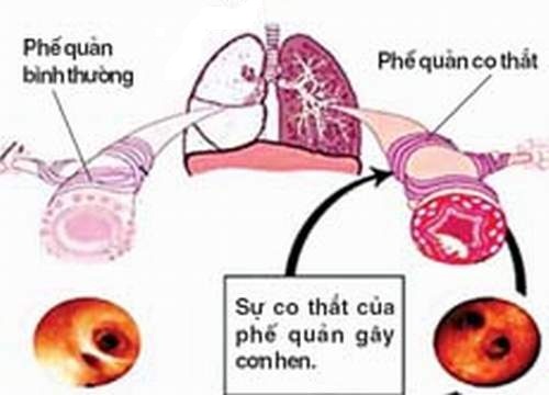 Hình ảnh phổi bình thường và phổi bị co thắt ở bệnh nhân bị hen.