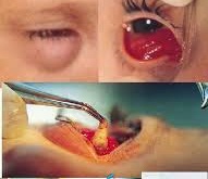 Hậu quả nghiêm trọng từ việc lạm dụng kính áp tròng.
