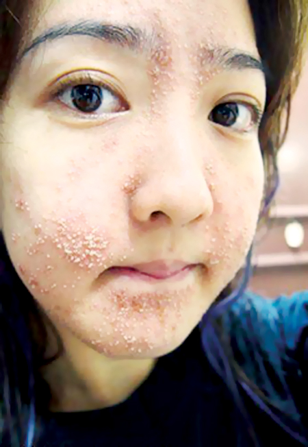 Da bị dị ứng với thuốc làm trắng.