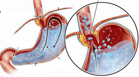 Hình ảnh trào ngược dạ dày, thực quản