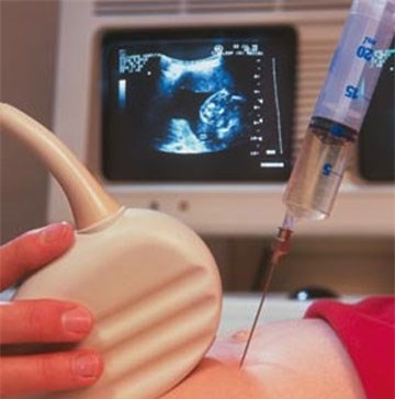 Chọc dò ối thường được thực hiện vào tuần thứ 16-18 của thai kỳ.