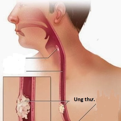 Ung thư thực quản - một nguyên nhân gây khó nuốt.