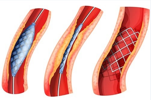 Phương pháp đặt stent can thiệp nội mạch giúp bệnh nhân nhanh chóng phục hồi sau mổ.