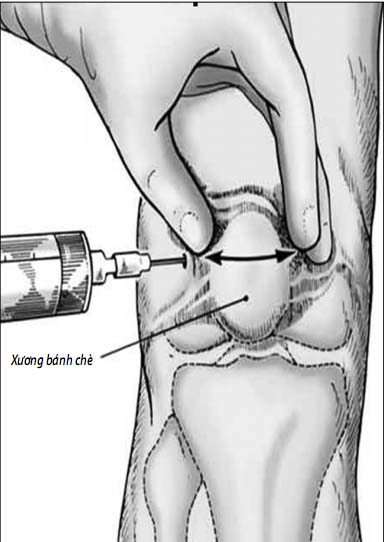 Tiêm thuốc vào khớp cần được thực hiện tại cơ sở y tế.