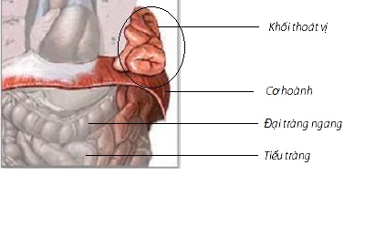 Hình ảnh thoát vị hoành.