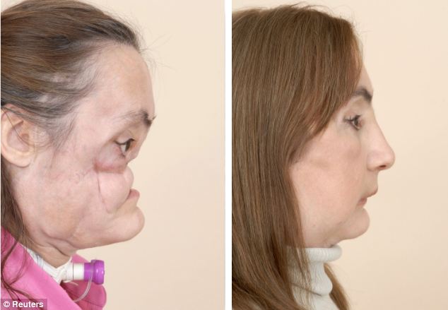 Hình ảnh trước và sau ca phẫu thuật ghép mặt đầu tiên tại Mỹ năm 2008.