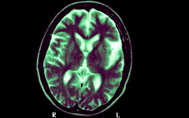 Hình ảnh não bệnh nhân Alzheimer.
