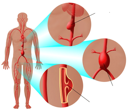 Các vị trí động mạch chủ dễ bị phồng Các vị trí động mạch chủ dễ bị phồng