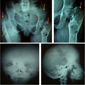 Tổn thương xương trong hội chứng 
                                                                McCune-Albright trên phim xquang 
