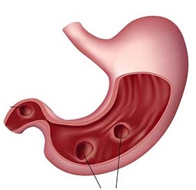 Loét dạ dày dùng thuốc dễ bị chảy máu dạ dày.