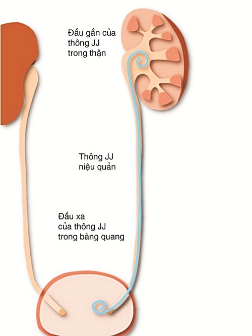 Hình ảnh sỏi rất nhiều ở niệu quản, đặt ống thông JJ để giải áp nước tiểu