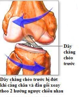 Đứt dây chằng chéo trước Triệu chứng, chẩn đoán và điều trị