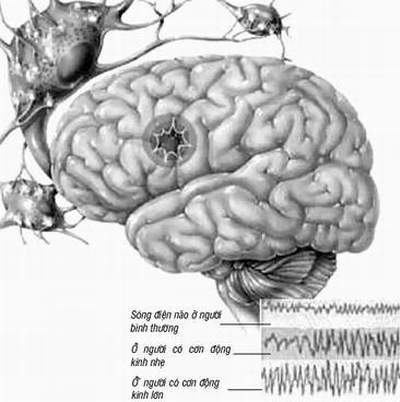 Hình ảnh sóng điện não của người bệnh động kinh.