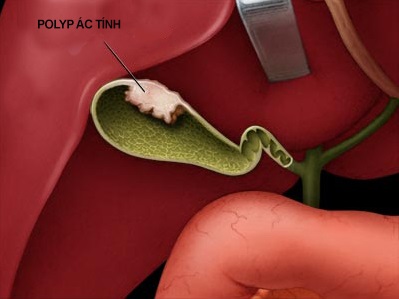 Sơ đồ mô tả một trường hợp polyp ung thư túi mật.