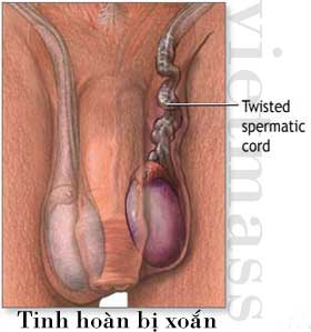 Tinh hoàn bình thường ( phải) và   tinh hoàn bị xoắn ( trái) - ở vị trí cao hơn