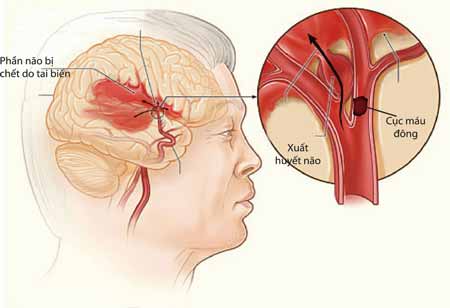 Tăng huyết áp gây tai biến mạch máu não dẫn dến tử vong