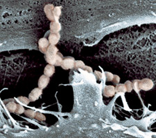 Liên cầu lợn Streptococus suis                                gây bệnh ở người